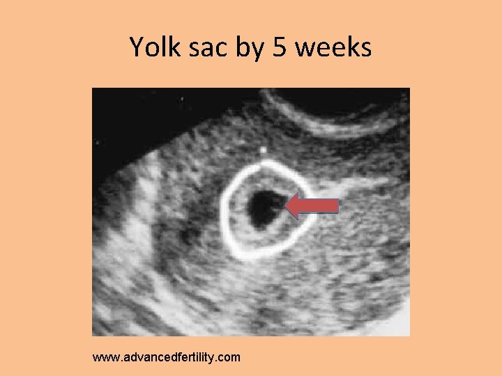 Yolk sac by 5 weeks www. advancedfertility. com 