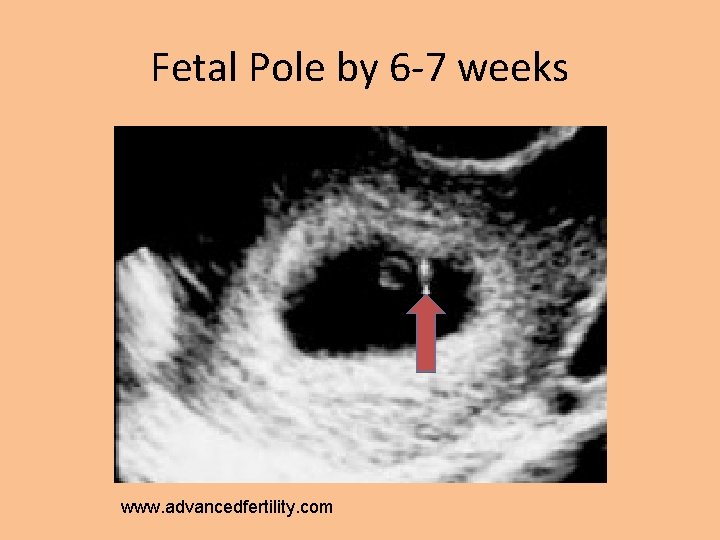 Fetal Pole by 6 -7 weeks www. advancedfertility. com 