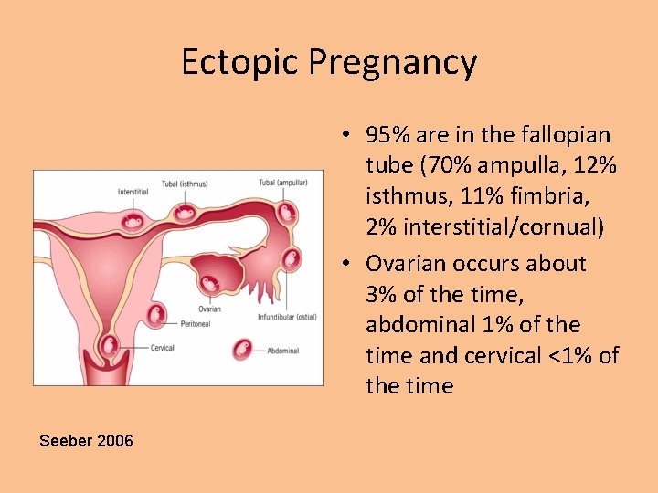 Ectopic Pregnancy • 95% are in the fallopian tube (70% ampulla, 12% isthmus, 11%
