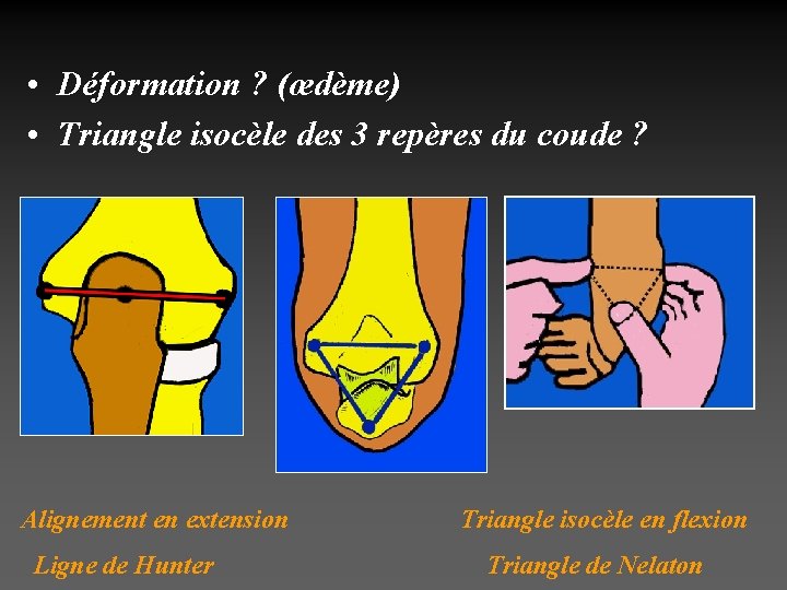  • Déformation ? (œdème) • Triangle isocèle des 3 repères du coude ?