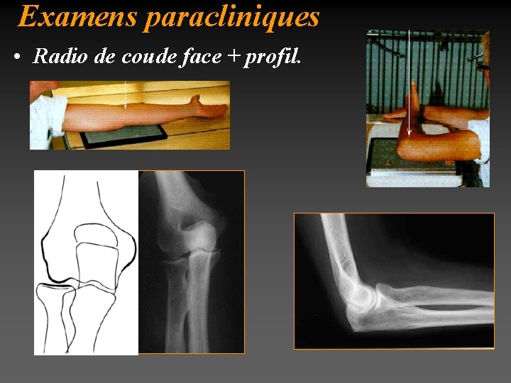 Examens paracliniques • Radio de coude face + profil. 