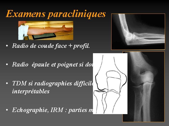 Examens paracliniques • Radio de coude face + profil. • Radio épaule et poignet