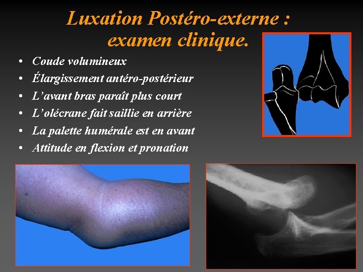 Luxation Postéro-externe : examen clinique. • • • Coude volumineux Élargissement antéro-postérieur L’avant bras