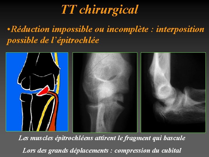 TT chirurgical • Réduction impossible ou incomplète : interposition possible de l’épitrochlée Les muscles