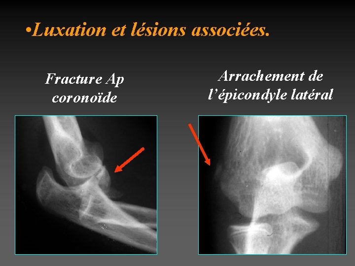  • Luxation et lésions associées. Fracture Ap coronoïde Arrachement de l’épicondyle latéral 