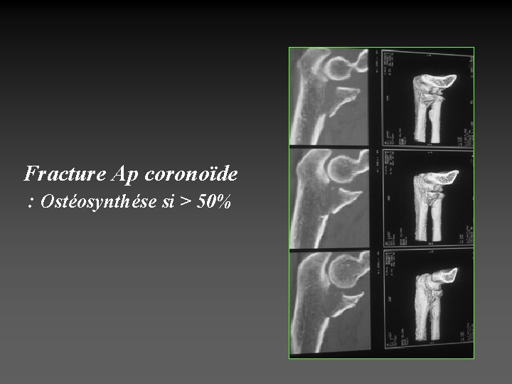 Fracture Ap coronoïde : Ostéosynthése si > 50% 