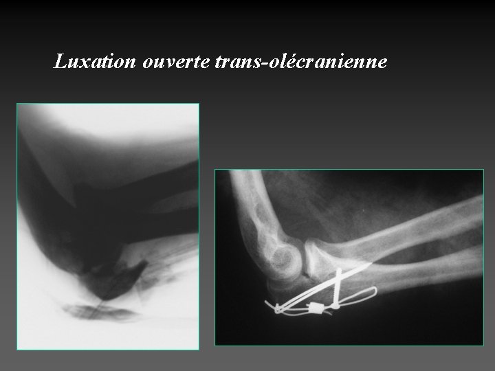 Luxation ouverte trans-olécranienne 