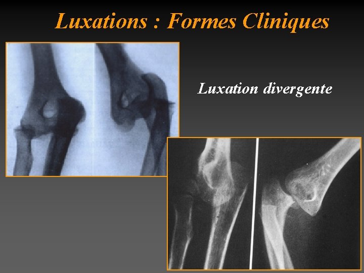 Luxations : Formes Cliniques Luxation divergente 