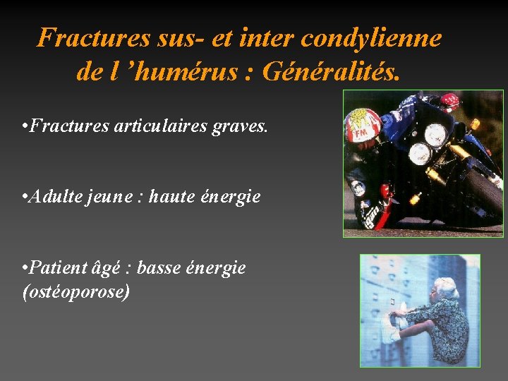 Fractures sus- et inter condylienne de l ’humérus : Généralités. • Fractures articulaires graves.