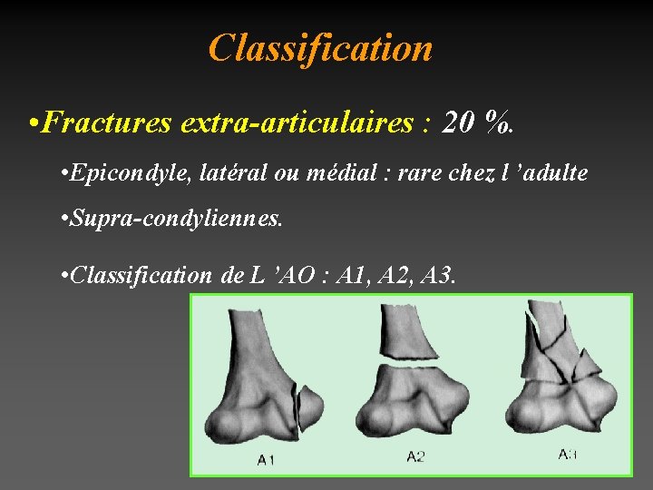 Classification • Fractures extra-articulaires : 20 %. • Epicondyle, latéral ou médial : rare