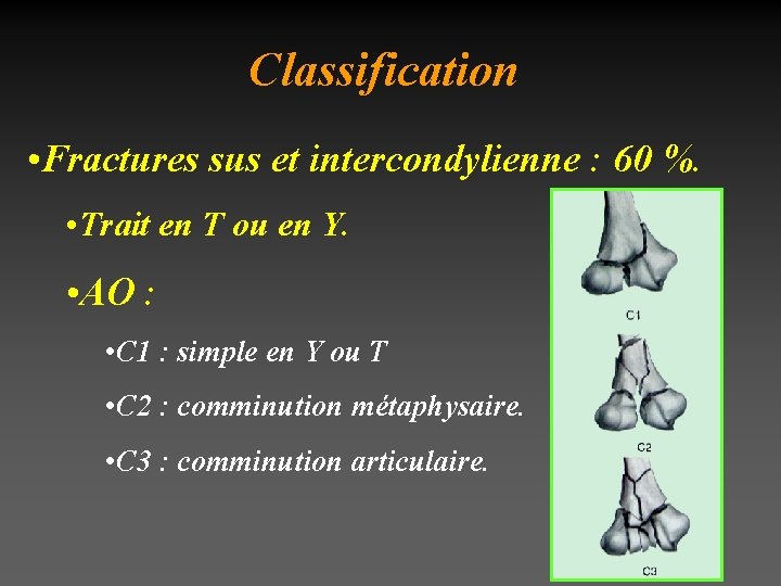 Classification • Fractures sus et intercondylienne : 60 %. • Trait en T ou