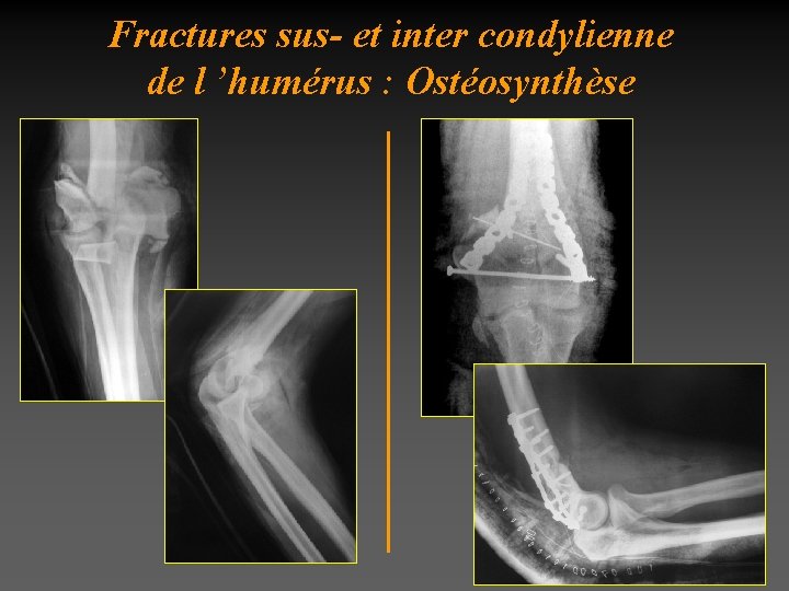 Fractures sus- et inter condylienne de l ’humérus : Ostéosynthèse 