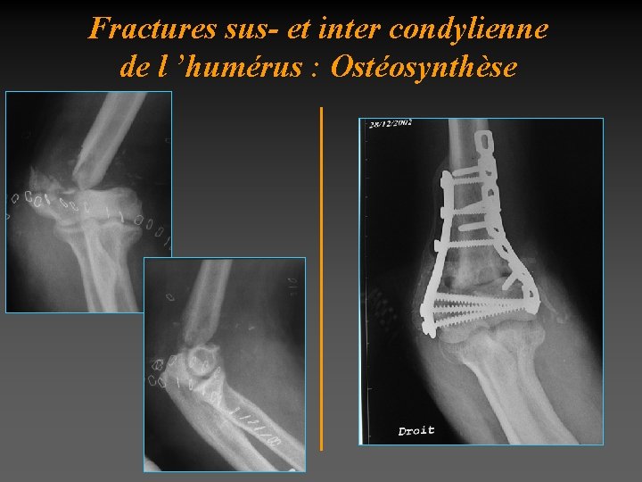 Fractures sus- et inter condylienne de l ’humérus : Ostéosynthèse 