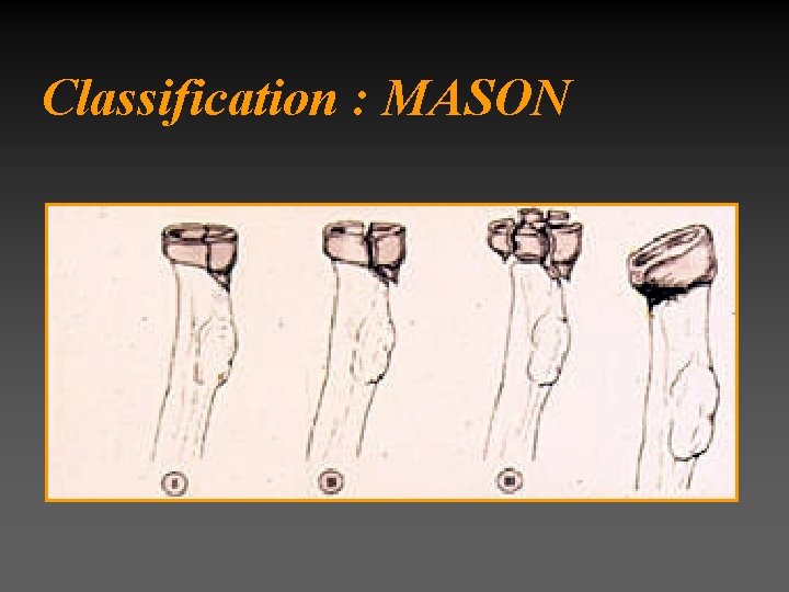 Classification : MASON 