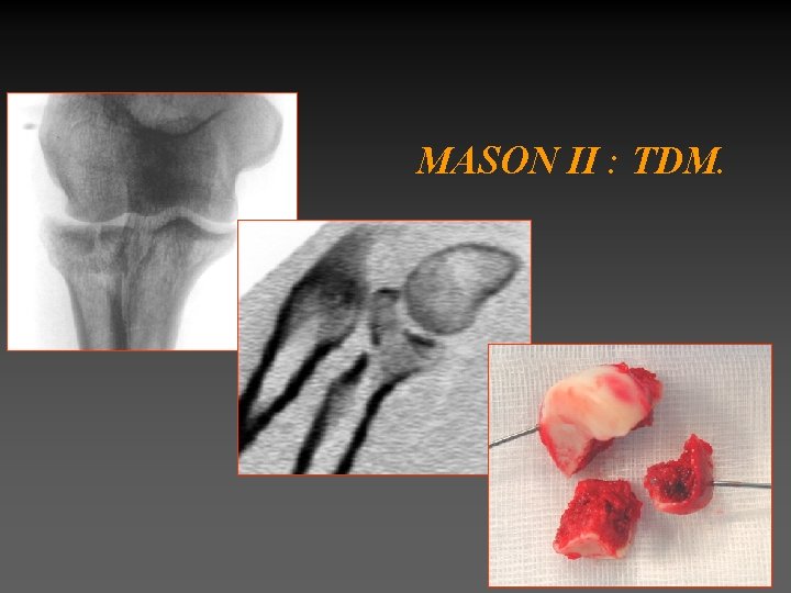 MASON II : TDM. 