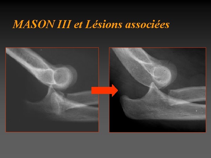 MASON III et Lésions associées 