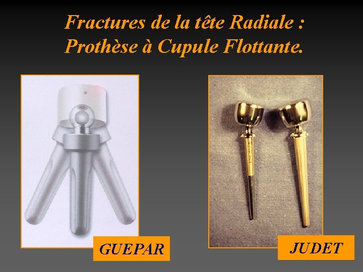Fractures de la tête Radiale : Prothèse à Cupule Flottante. GUEPAR JUDET 