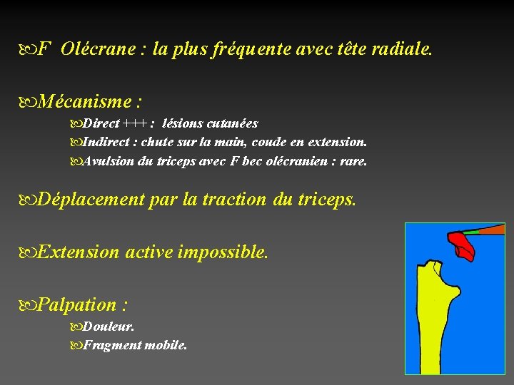  F Olécrane : la plus fréquente avec tête radiale. Mécanisme : Direct +++