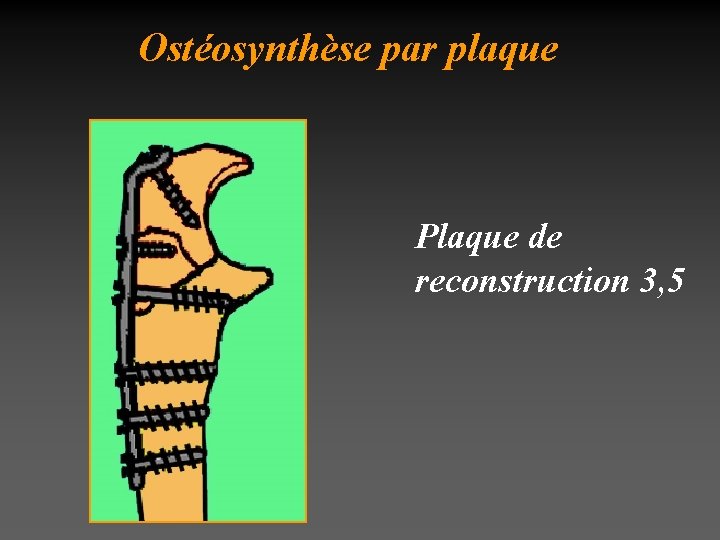 Ostéosynthèse par plaque Plaque de reconstruction 3, 5 