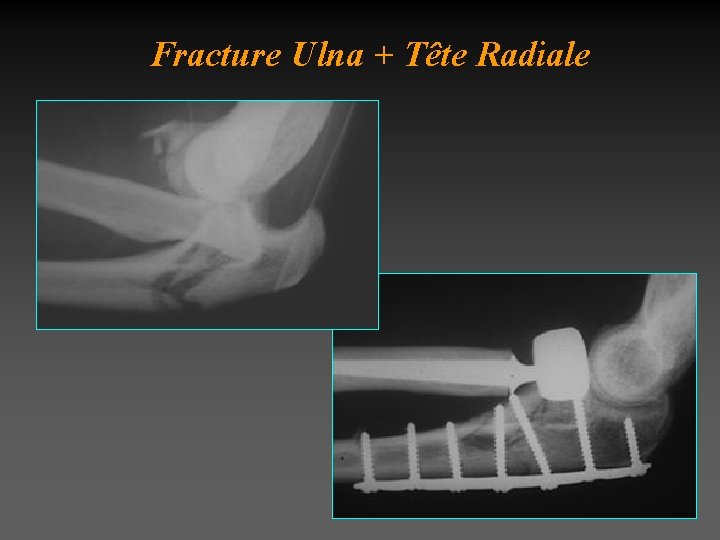  Fracture Ulna + Tête Radiale 