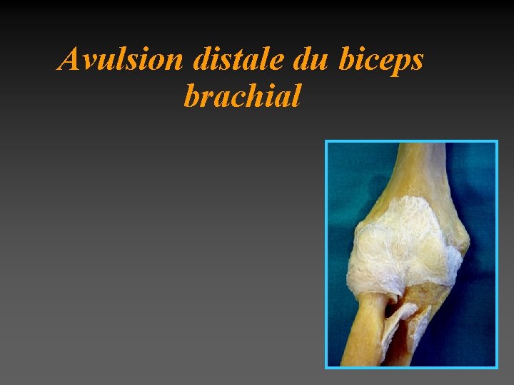 Avulsion distale du biceps brachial 