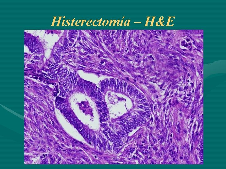 Histerectomía – H&E 