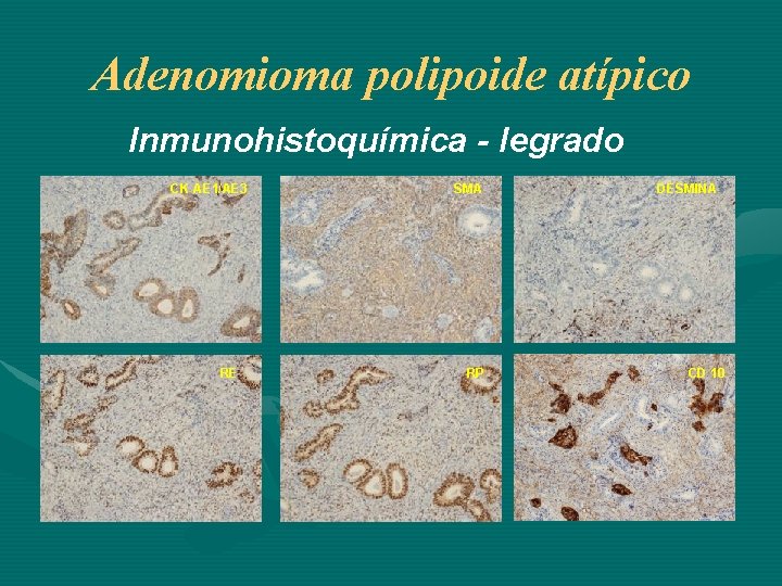 Adenomioma polipoide atípico Inmunohistoquímica - legrado CK AE 1/AE 3 RE SMA RP DESMINA