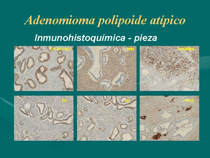 Adenomioma polipoide atípico Inmunohistoquímica - pieza CK AE 1/AE 3 RE SMA RP DESMINA
