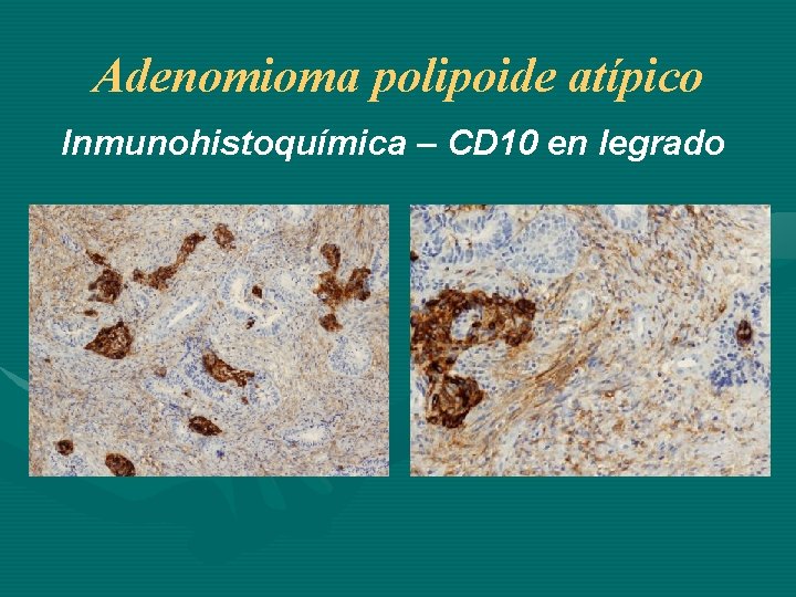 Adenomioma polipoide atípico Inmunohistoquímica – CD 10 en legrado 