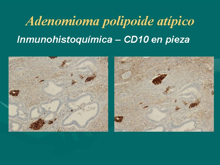 Adenomioma polipoide atípico Inmunohistoquímica – CD 10 en pieza 