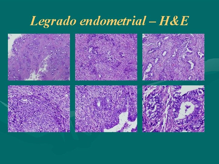 Legrado endometrial – H&E 