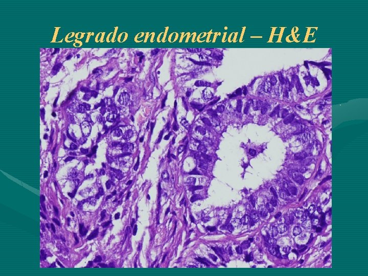 Legrado endometrial – H&E 