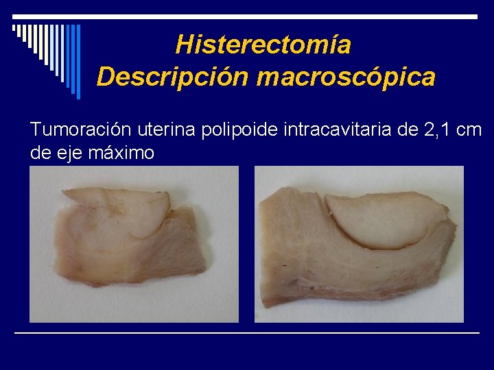 Histerectomía Descripción macroscópica Tumoración uterina polipoide intracavitaria de 2, 1 cm de eje máximo