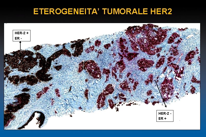 ETEROGENEITA’ TUMORALE HER 2 HER-2 + ER - HER-2 ER + 