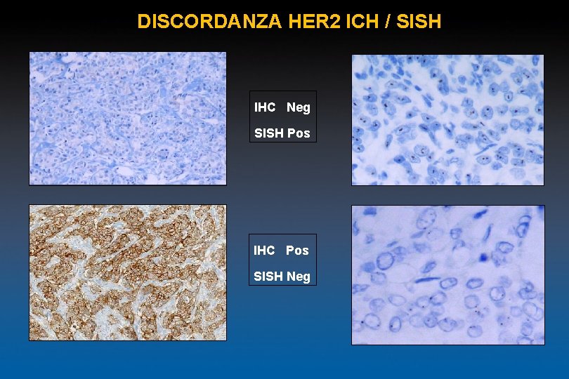 DISCORDANZA HER 2 ICH / SISH IHC Neg SISH Pos IHC Pos SISH Neg