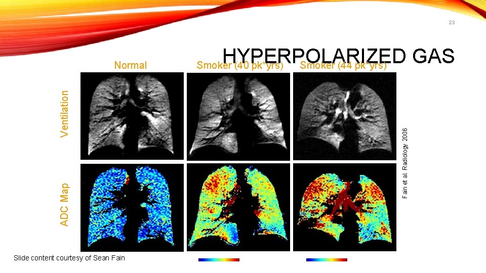 23 HYPERPOLARIZED GAS Smoker (44 pk*yrs) Smoker (40 pk*yrs) ADC Map Fain et al.