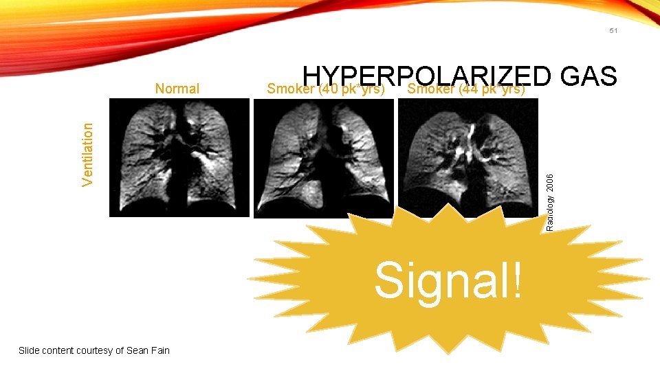 51 HYPERPOLARIZED GAS Smoker (44 pk*yrs) Signal! Slide content courtesy of Sean Fain 0