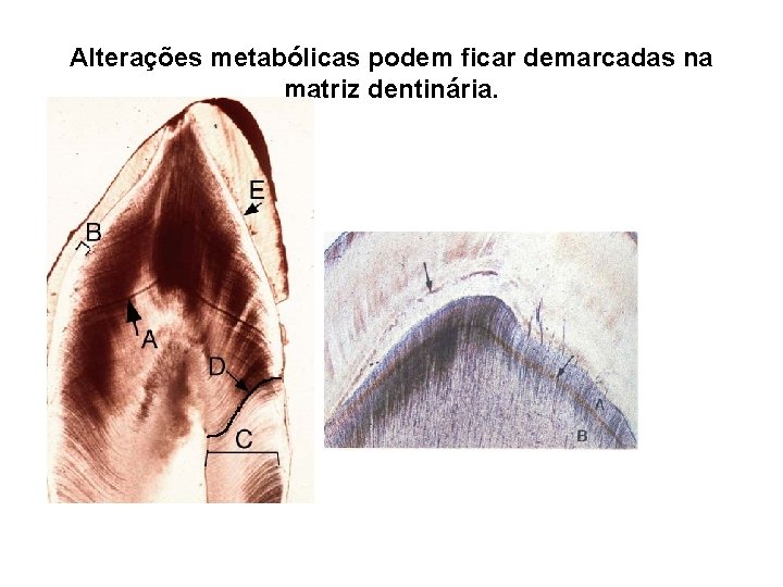 Alterações metabólicas podem ficar demarcadas na matriz dentinária. 