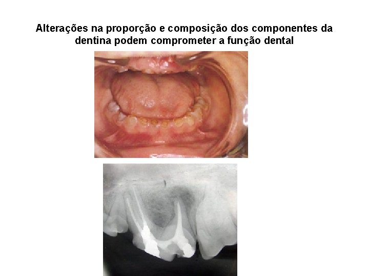 Alterações na proporção e composição dos componentes da dentina podem comprometer a função dental