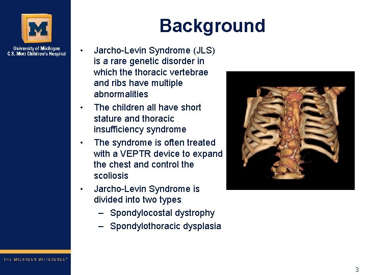 Background • • Jarcho-Levin Syndrome (JLS) is a rare genetic disorder in which the