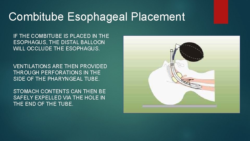 Combitube Esophageal Placement IF THE COMBITUBE IS PLACED IN THE ESOPHAGUS, THE DISTAL BALLOON Combitube Esophageal Placement IF THE COMBITUBE IS PLACED IN THE ESOPHAGUS, THE DISTAL BALLOON