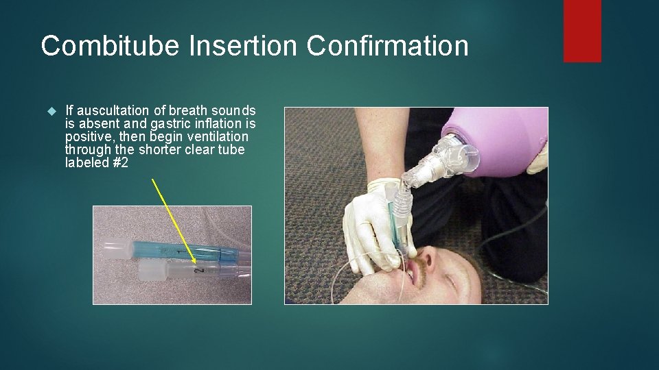 Combitube Insertion Confirmation If auscultation of breath sounds is absent and gastric inflation is Combitube Insertion Confirmation If auscultation of breath sounds is absent and gastric inflation is
