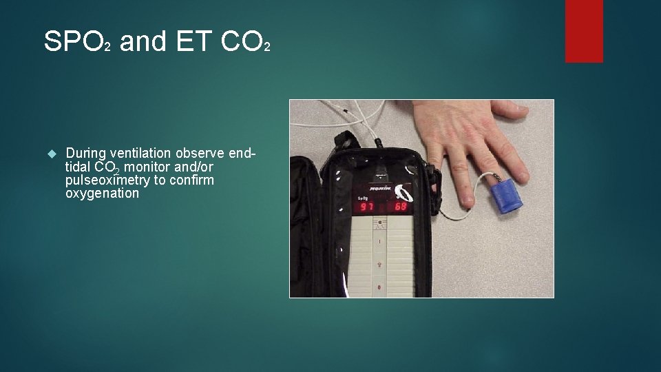 SPO 2 and ET CO 2 During ventilation observe endtidal CO 2 monitor and/or SPO 2 and ET CO 2 During ventilation observe endtidal CO 2 monitor and/or