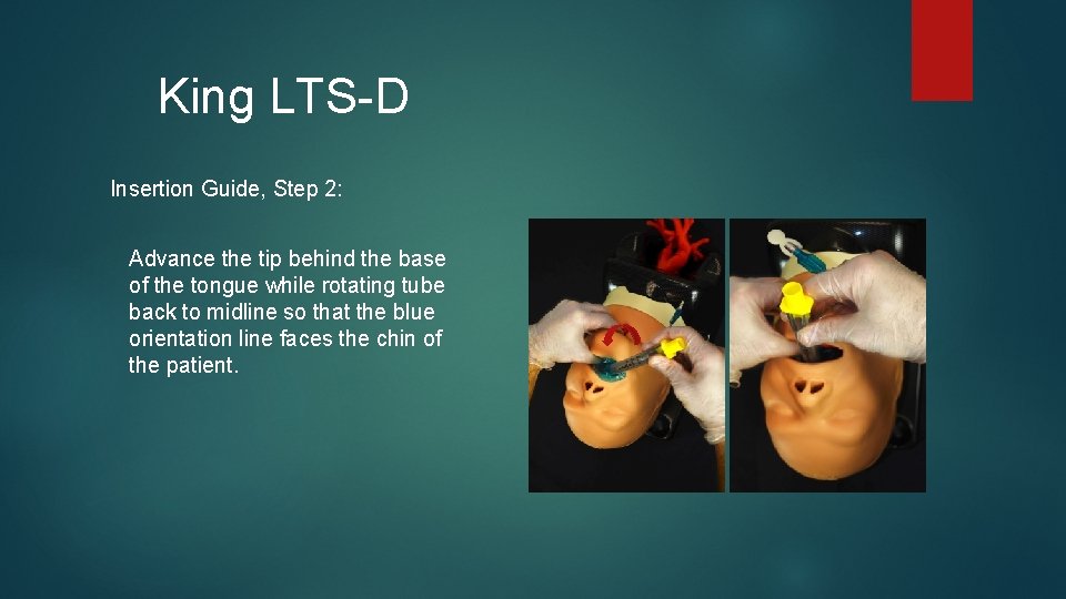 King LTS-D Insertion Guide, Step 2: Advance the tip behind the base of the King LTS-D Insertion Guide, Step 2: Advance the tip behind the base of the
