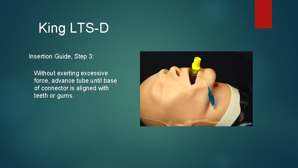 King LTS-D Insertion Guide, Step 3: Without exerting excessive force, advance tube until base King LTS-D Insertion Guide, Step 3: Without exerting excessive force, advance tube until base
