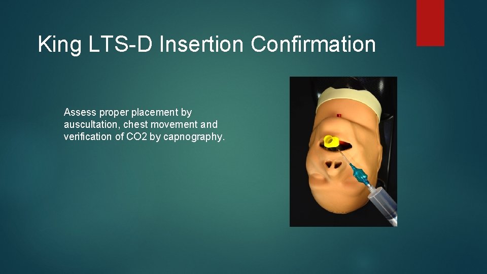 King LTS-D Insertion Confirmation Assess proper placement by auscultation, chest movement and verification of King LTS-D Insertion Confirmation Assess proper placement by auscultation, chest movement and verification of
