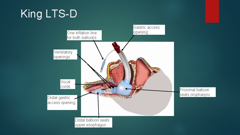 King LTS-D One inflation line for both balloons Gastric access opening Ventilatory openings Vocal King LTS-D One inflation line for both balloons Gastric access opening Ventilatory openings Vocal