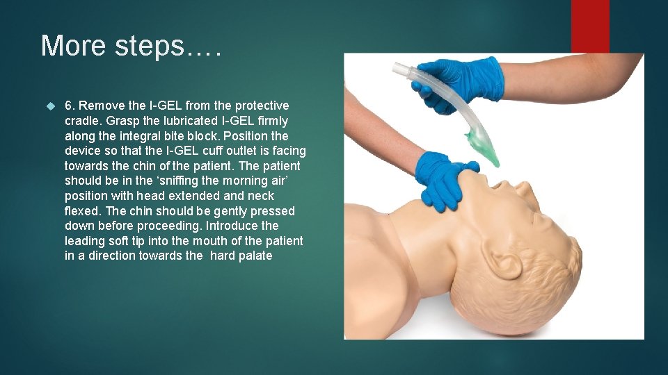 More steps…. 6. Remove the I-GEL from the protective cradle. Grasp the lubricated I-GEL More steps…. 6. Remove the I-GEL from the protective cradle. Grasp the lubricated I-GEL