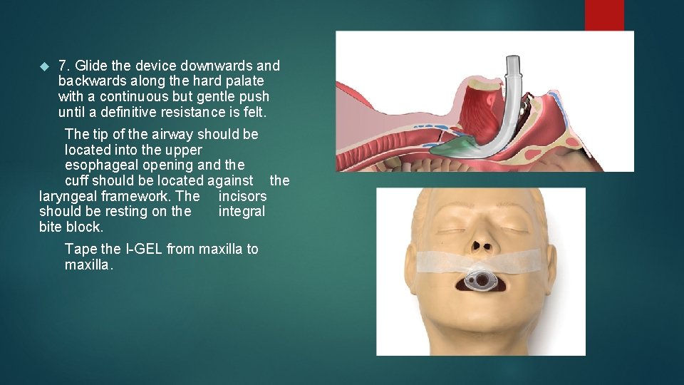 7. Glide the device downwards and backwards along the hard palate with a 7. Glide the device downwards and backwards along the hard palate with a