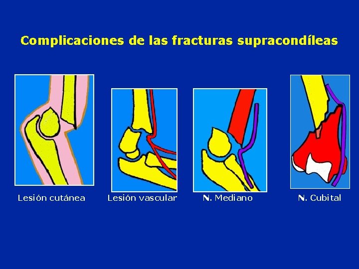 Complicaciones de las fracturas supracondíleas Lesión cutánea Lesión vascular N. Mediano N. Cubital 